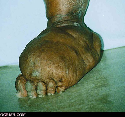 Elephantitis foot